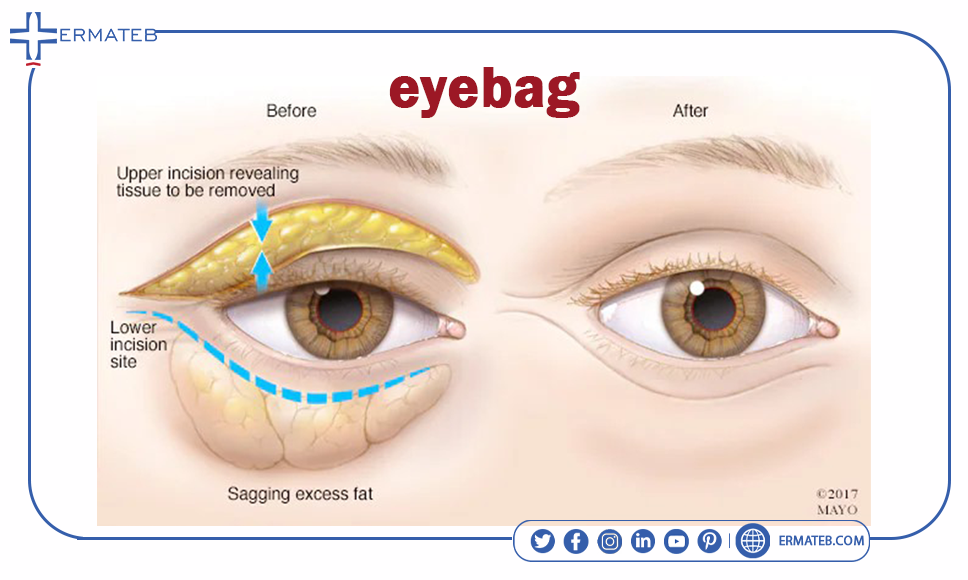 eye bag surgery procedure